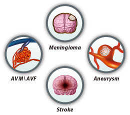Meningioma AVM/AVF Aneurysm Stroke