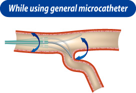 While using general microcatheter