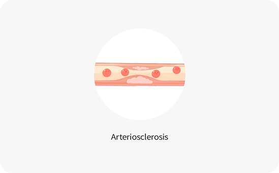 Arteriosclerosis