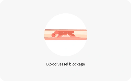 Blood vessel blockage